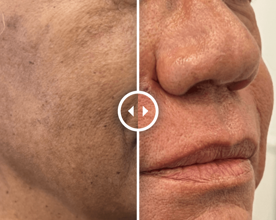 Tratamento de Rejuvenescimento